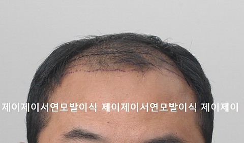 c형탈모 모발이식후 2년 6개월후 