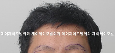 눈썹이식전후 