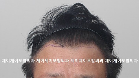 엠자탈모 정수리 탈모 이식후 6개월 