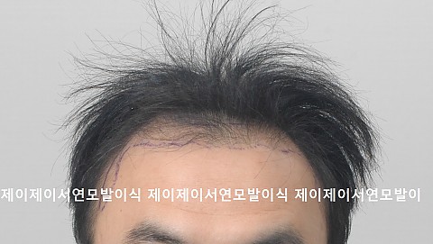 엠자 모발이식후 5개월 15일 경과(수술전 ,직후, 2주, 5개월 15일후) 