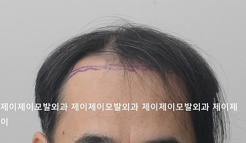 5000모 (약 2500모낭) 모발이식후 5개월 10일 경과 
