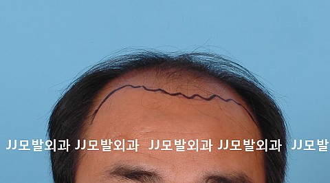 모발이식후 8년 경과 