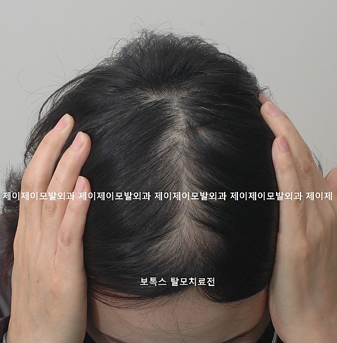 보톡스 탈모치료 