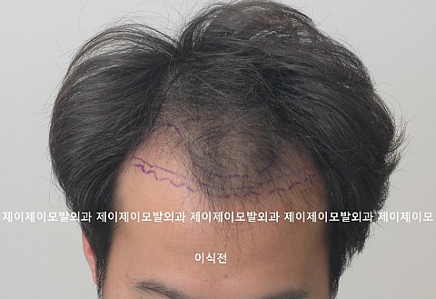 4500모 모발이식후 6개월 경과 