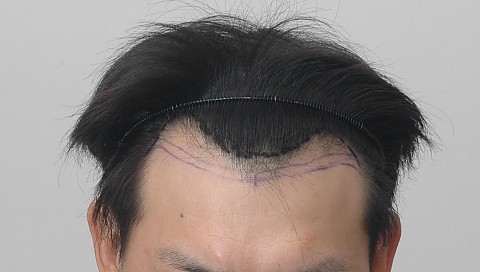 절개법 3000모 , m자탈모 이식 3년경과 