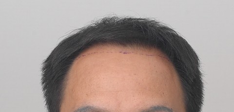 모발이식전후 앞머리와 정수리 