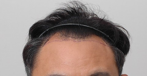 모발이식 4500모 6개월전후 
