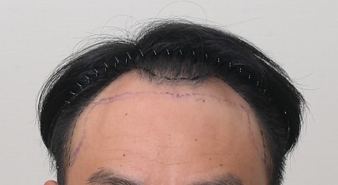 4000모 절개 모발이식 6개월 전후 