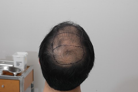 정수리 모발이식 전후 