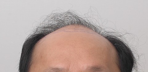 비절개 모발이식 6개월전후 