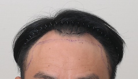 m자 탈모 모발이식 전후 