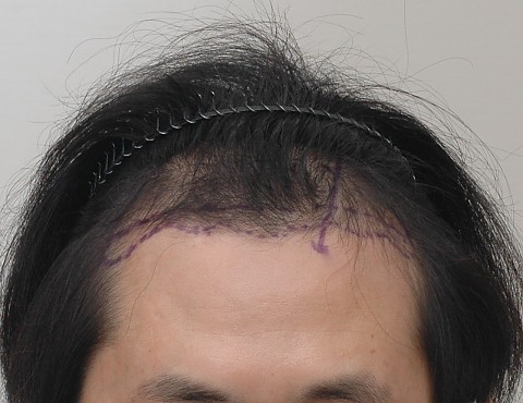 모발이식 전후 9개월 