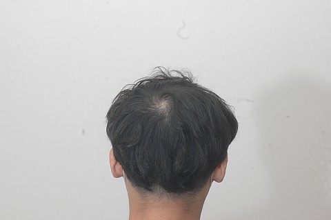 비절개 모발이식2주후 모낭채취부위와 경과 