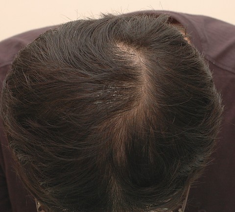 정수리 탊보 치료전후 
