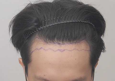 남자 비절개헤어라인모발이식 2주 전후 