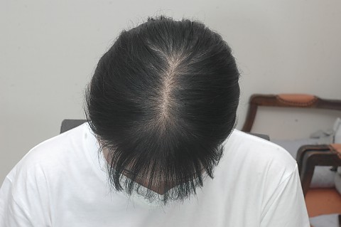 여성탈모치료 