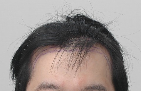 엠자 모발이식 