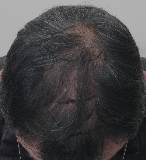 정수리 탈모 모발이식전,모발이식 직후,1년후 