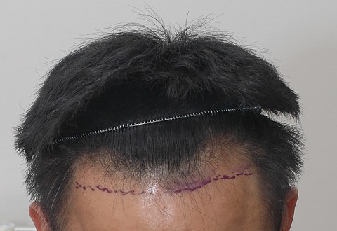 모발이식전,직후,2주후,9개월후 