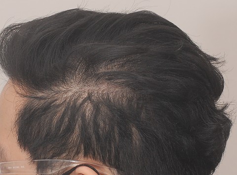 옆머리 탈모 치료전후 