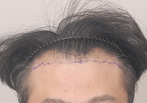 비절개 모발이식 9개월 전후(엠자 정수리 모발이식) 