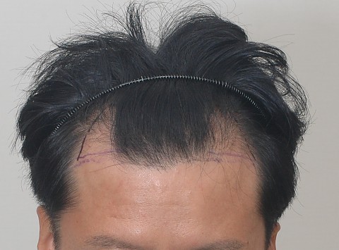 절개모발이식 경과 