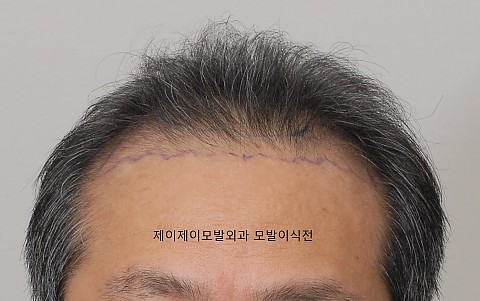 비절개 모발이식 4000모후 변화 
