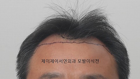 엠자탈모 정수리탈모 모발이식전후 