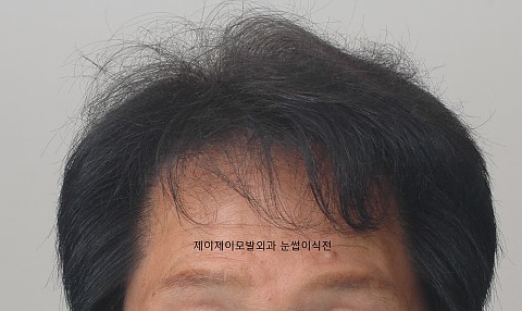 남성눈썹이식 