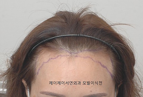 여성헤어라인 비절개 모발이식전후 
