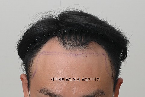 남자헤어라인 절개모발이식 
