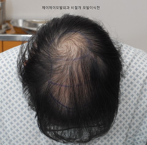 정수리탈모 비절개 모발이식 6개월 