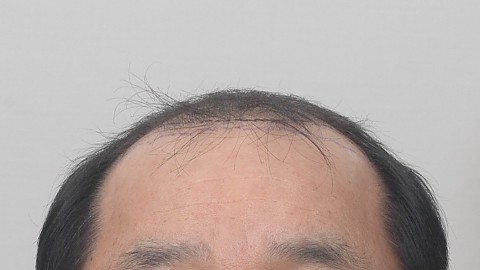 모발이식 전후 5년 경과 