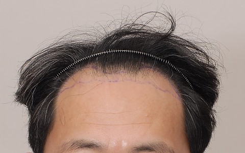 모발이식 5000모 엠자부위와 장수리부위 이식후 전후결과 