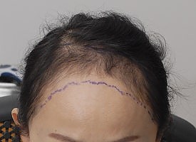 블로그에서 옮긴 수술전후사진 