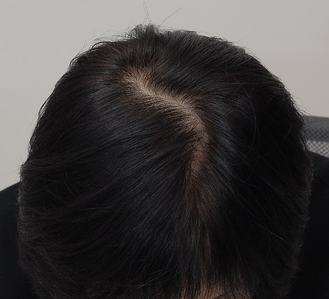 블로그에서 옮긴 치료전후 사진 