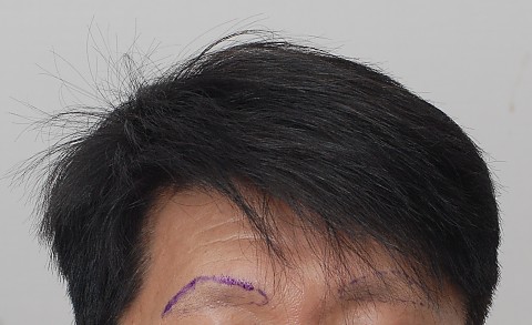 블로그에서 옮긴 눈썹이식전후사진 