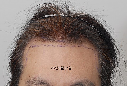 블로그에서 옮긴 전후사진, 