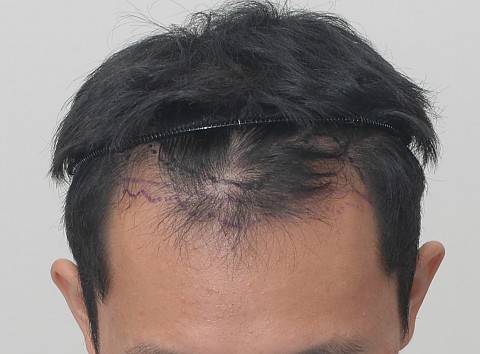 블로그에서 옮긴 수술전후사진 