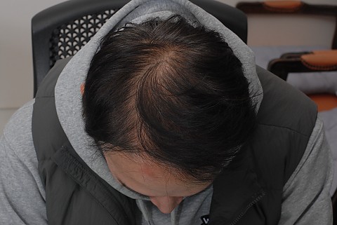 블로그에서 옮긴 시술전후 사진 