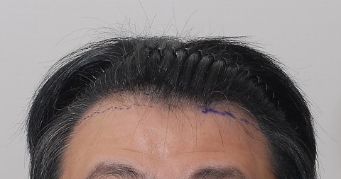 블로그에서 옮긴 수술전후 사진 