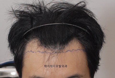 블로그에서 옮긴 수술전후사진,비절개 모발이식 6개월간의 변화,후두부는 2일후 2주후임. 