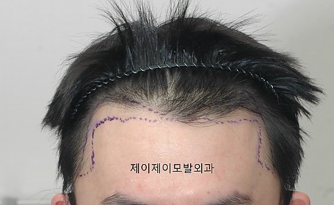 블로그에서 옮긴 수술후 변화사진 2주후 2년후 