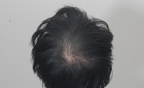블로그에서 옮긴 수술전후 사진 