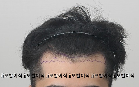 블로그에서 옮긴 수술전후 사진 