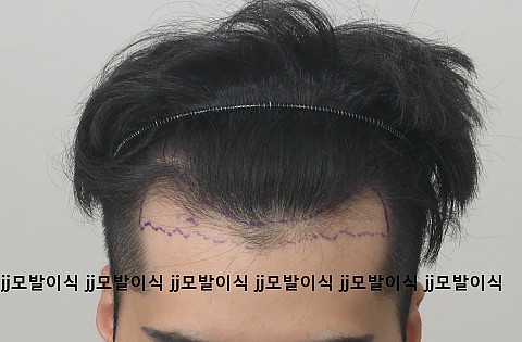 블로그에서 옮긴 수술전후사진들 
