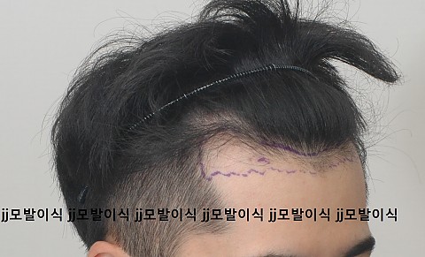 블로그에서 옮긴 엠자 3000모 모발이식후 변화과정 
