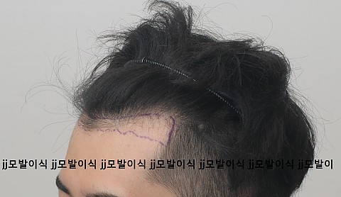 블로그에서 옮긴 남성엠자 탈모 3000모 모발이식후 9개월간의 변화 